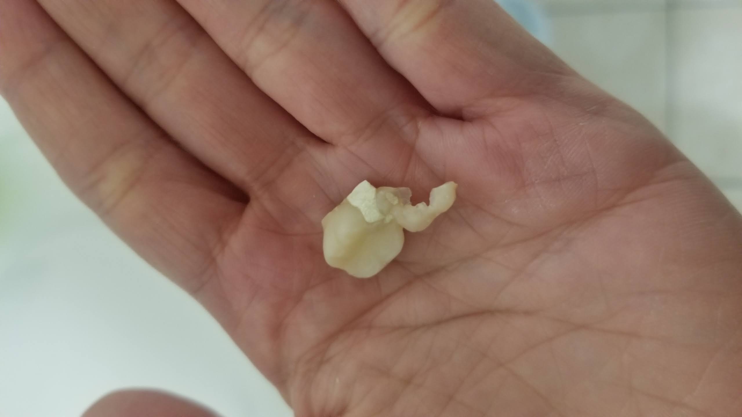 chipped tooth