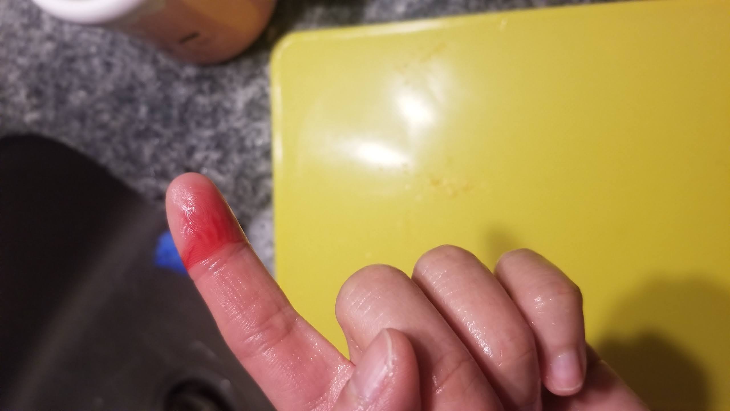 bleeding finger